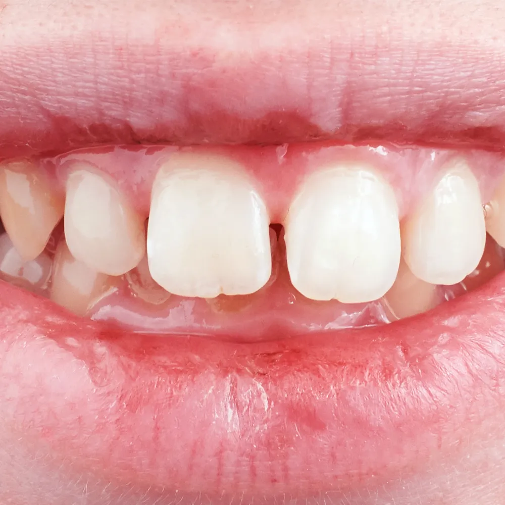 invisalign t1
