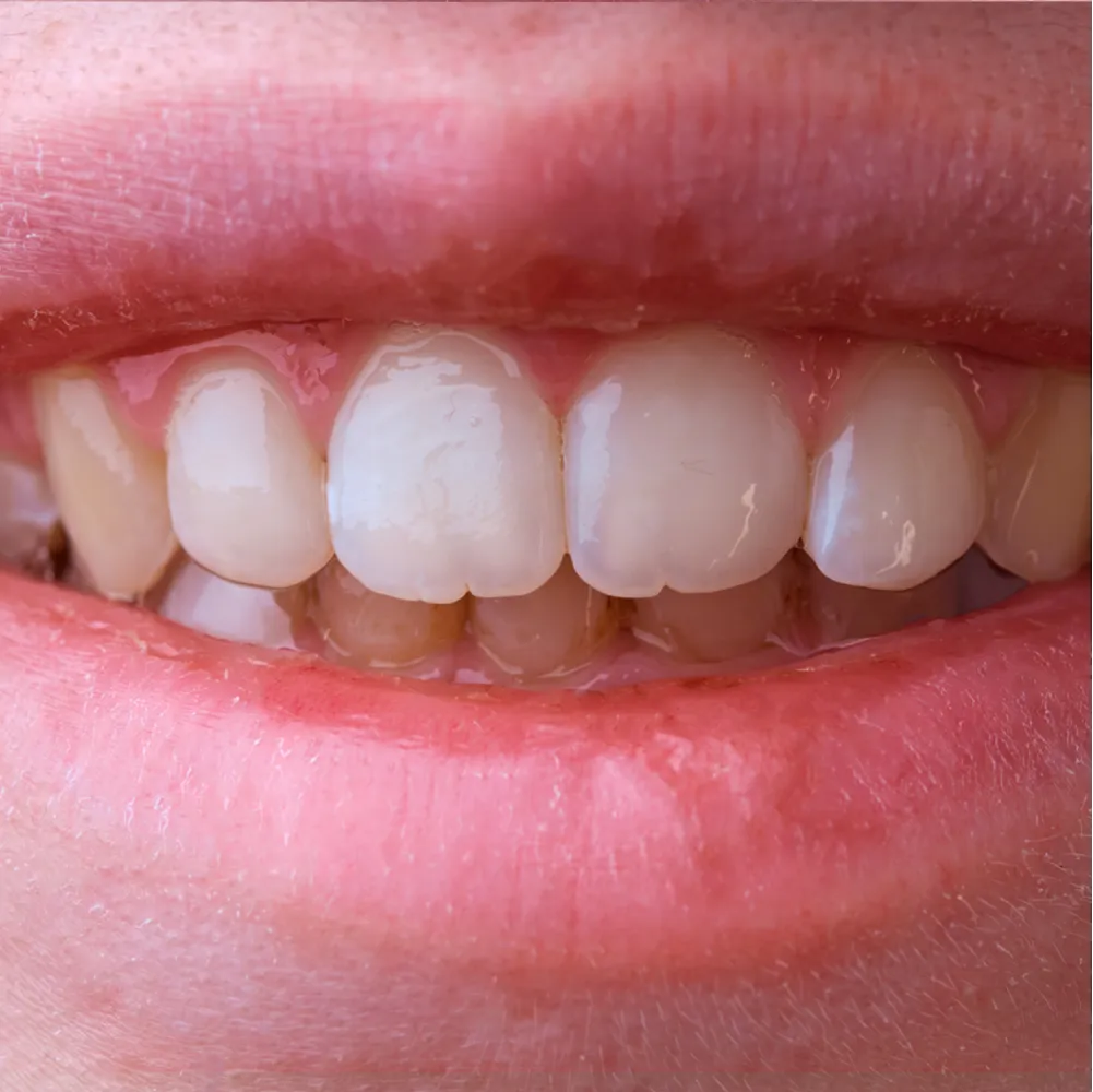 invisalign t2