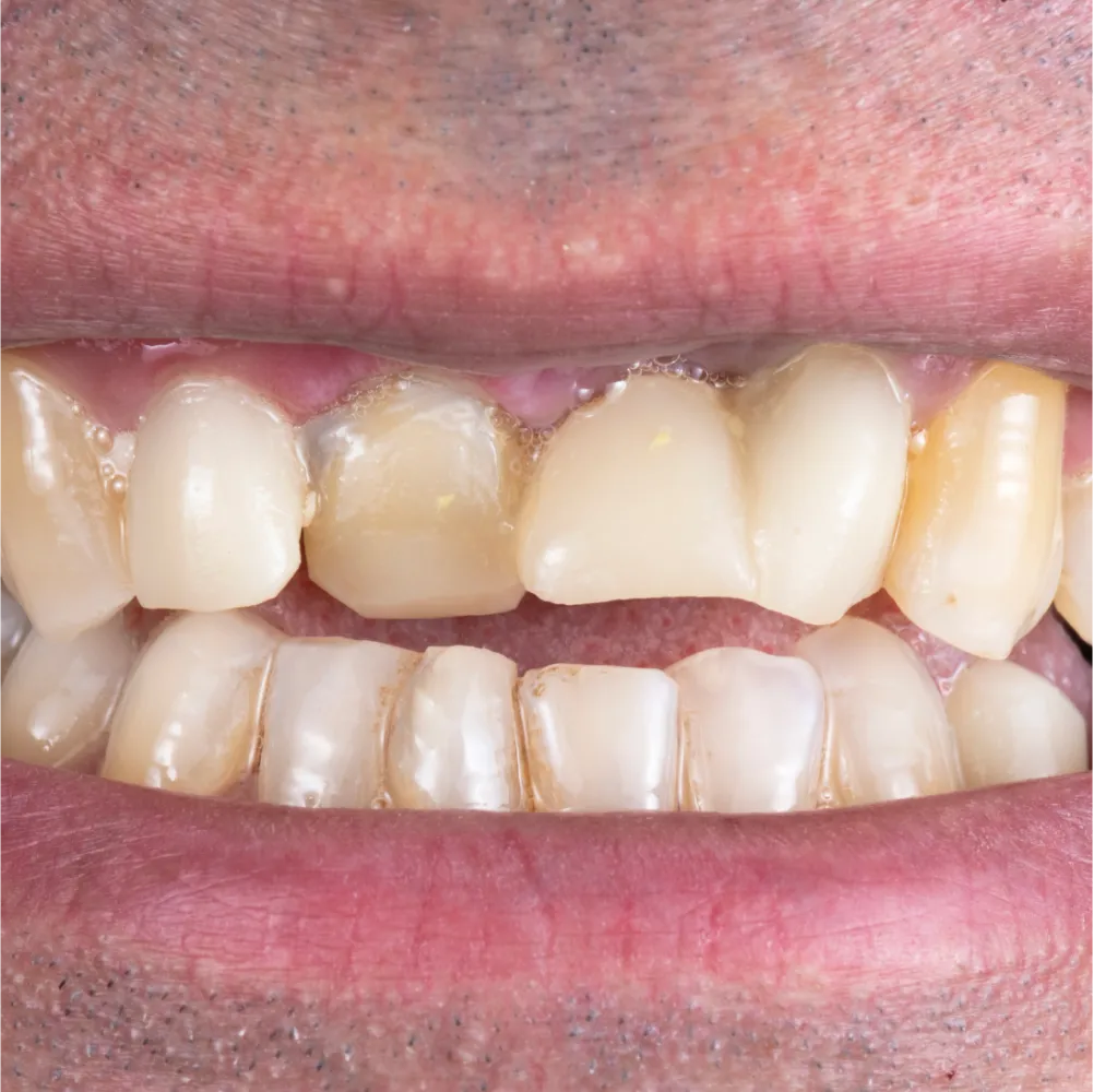 invisalign t5