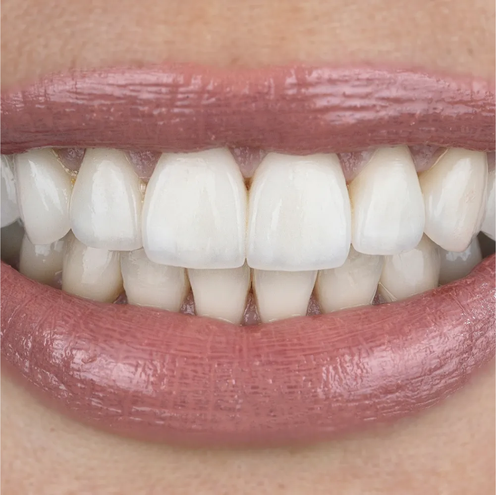 whitening t2