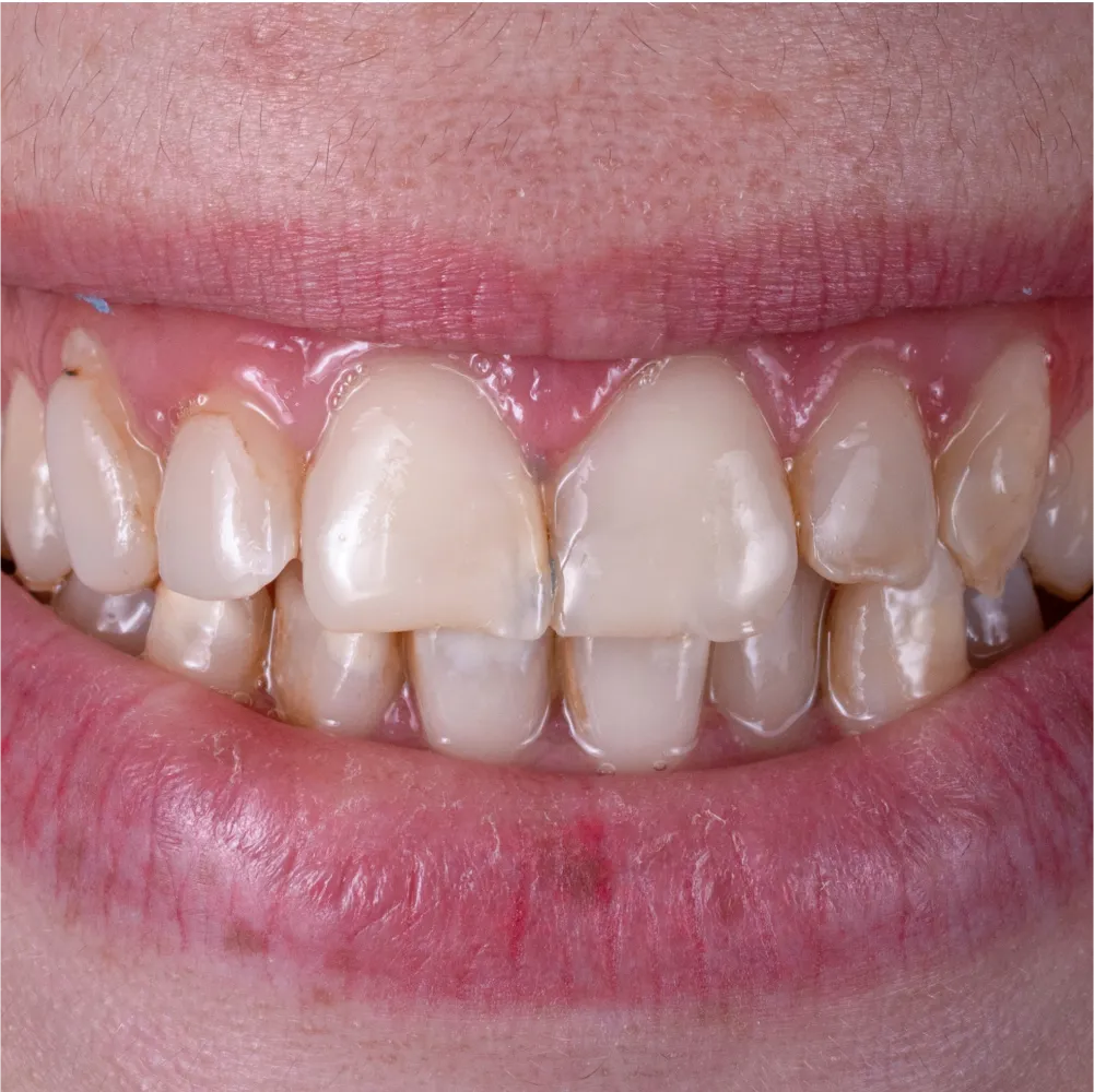 whitening t3